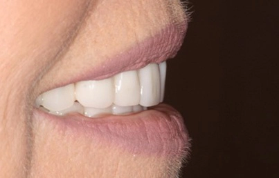 Closeup of smile after treatment